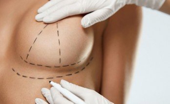 Golden rules that ensures faster recovery time after breast surgery