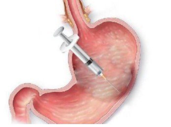 Gastric Botox Injection